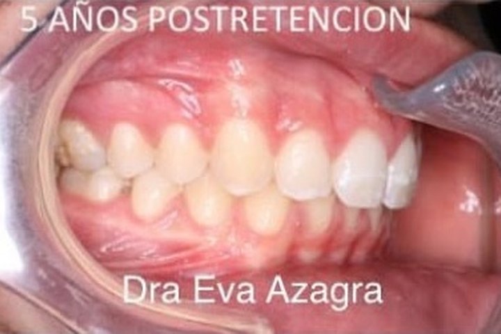 Vista lateral derecha en la revisión, cinco años después de retirar la ortodoncia