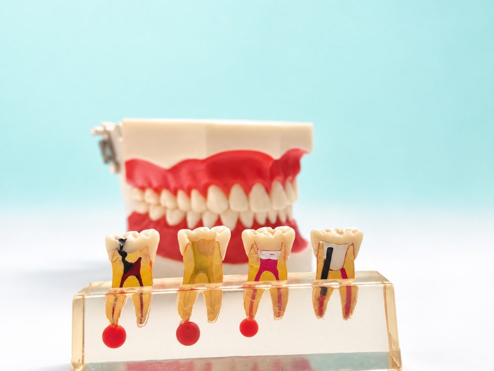 Modelo dental que muestra el interior de la raíz tras una endodoncia