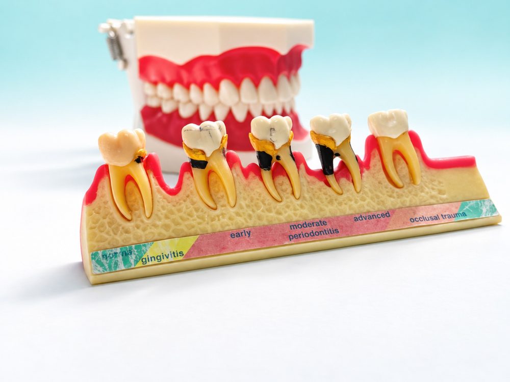 Modelo que muestra la evolución de gingivitis a periodontitis